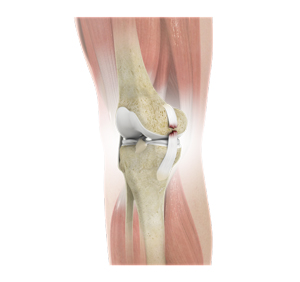 Medial Collateral Ligament (MCL) Tear Englewood