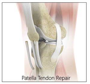 Final construct for patellar tendon primary repair using